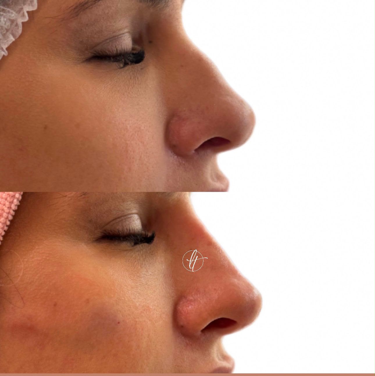 Antes e depois de preenchimento nasal