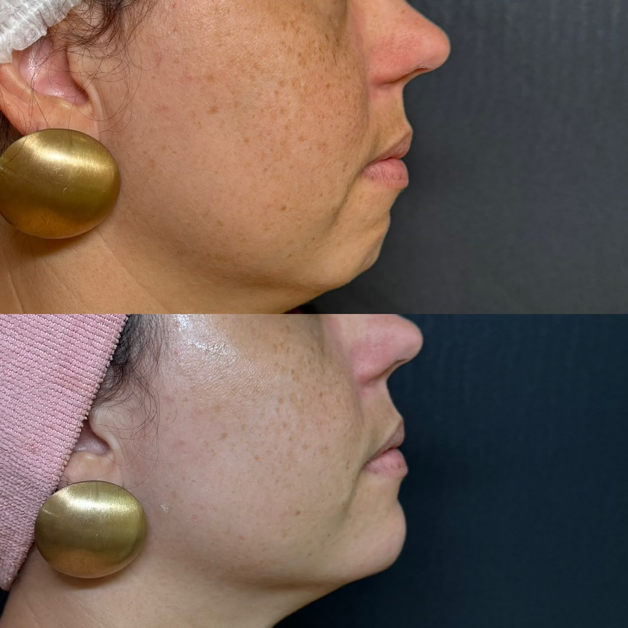 Caso clínico de perfil facial