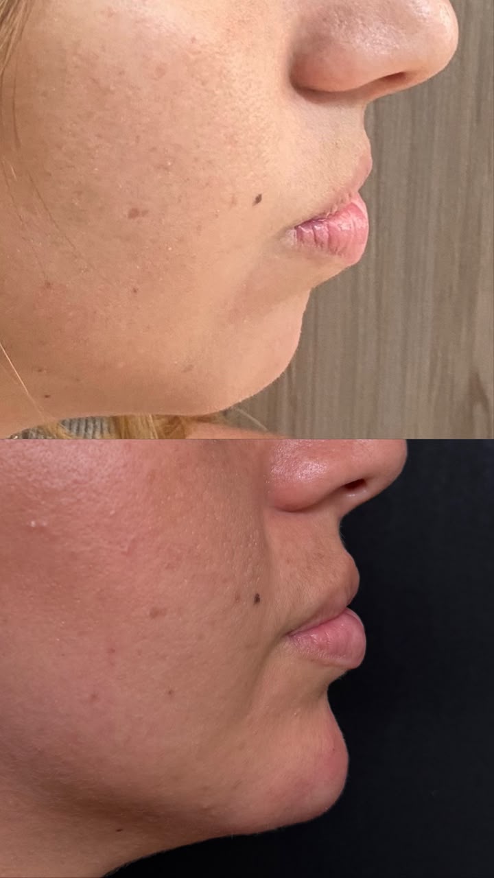 Antes e depois de perfiloplastia
