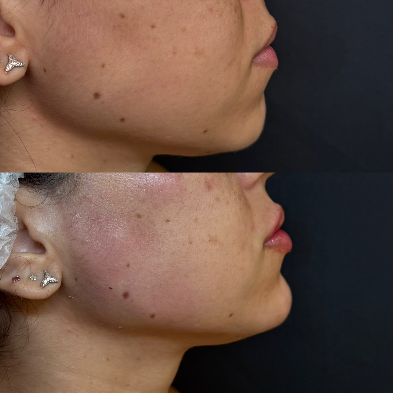 Resultado de perfiloplastia